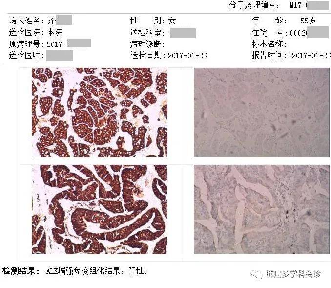 肺癌手术后复查_肺癌吃吉非替尼需要复查什么_克唑替尼治愈肺癌案例