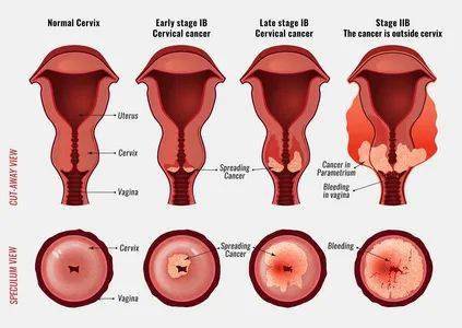 含铂方案化疗是晚期宫颈癌的一线治疗选择和希望