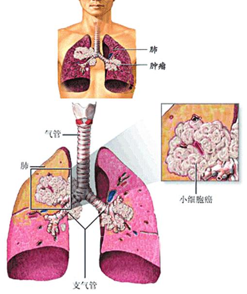肺癌怎么治疗?肺癌比较好的治疗方法有哪些?