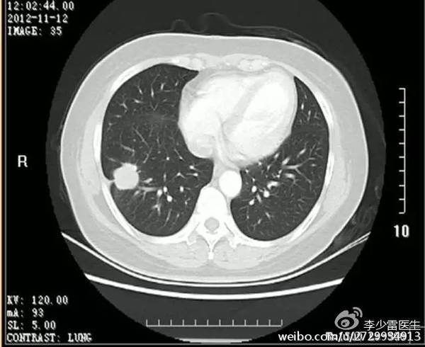 肺癌手术后可以贝伐单抗_贝伐单抗 肺癌_贝伐单抗多久有耐药性