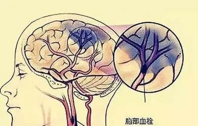 贝伐单抗和贝伐珠单抗_贝伐珠单抗是化疗药吗_贝伐单抗治脑部肿瘤