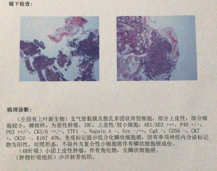 胃癌可以吃吉非替尼片_胃癌可以吃安利维生素c吗_盐酸地尼多芬片吃多了