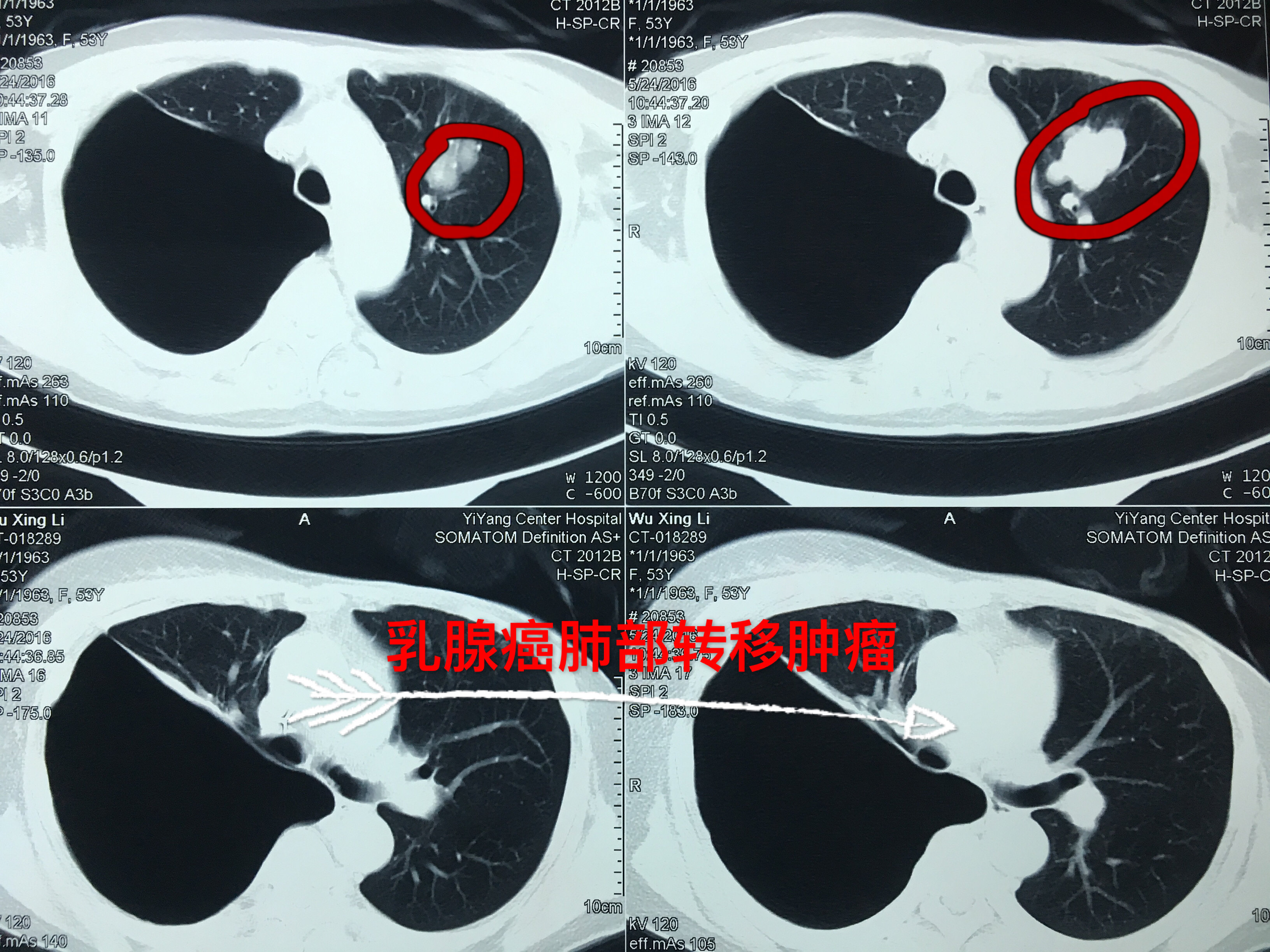 肺原位腺癌10年生存率_肺腺癌吃吉非替尼身体恢复_肺鳞癌和腺癌 切片区别