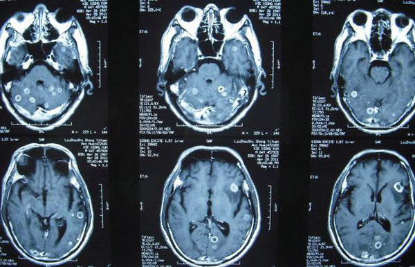 EGFR突变和ALK重排非小细胞肺癌，脑转移是怎么回事？