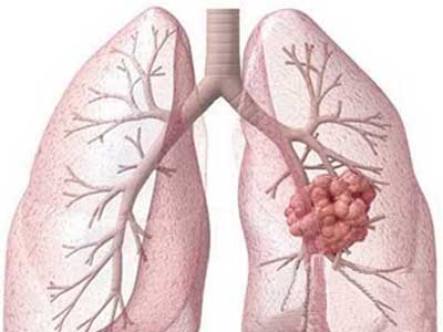 肺癌靶向药已不再是陌生事物，层出不穷的靶向药为