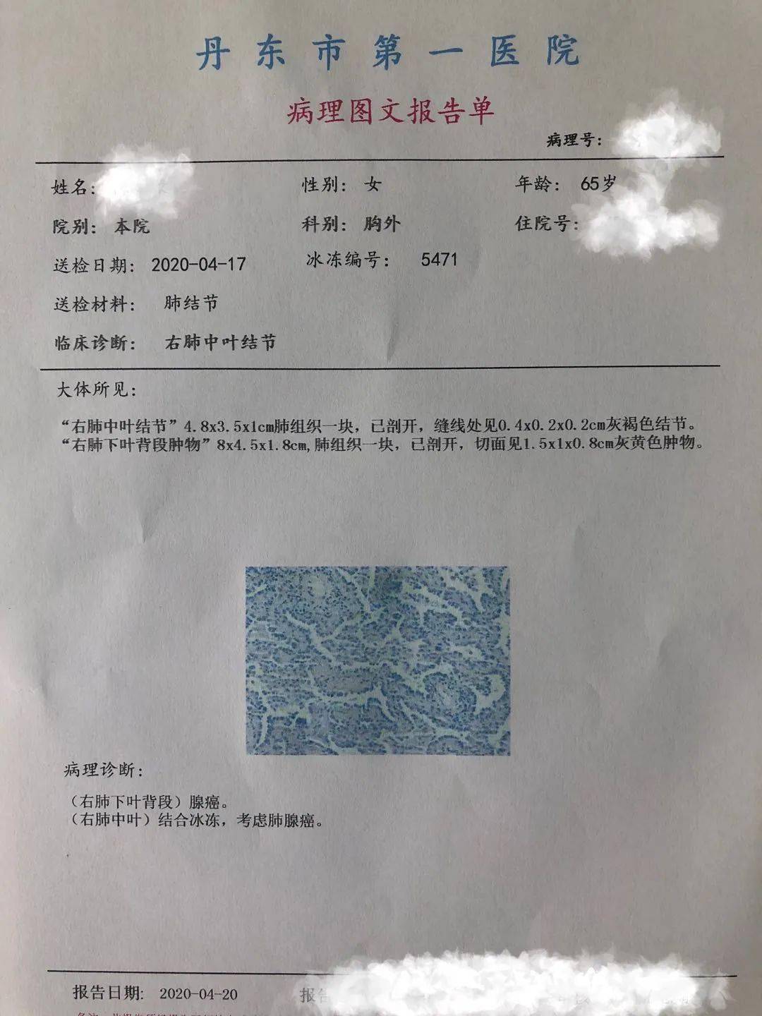 贝伐单抗多久有耐药性_贝伐单抗的抗肺癌效果_肺癌继发性癫痫可用贝伐单抗吗