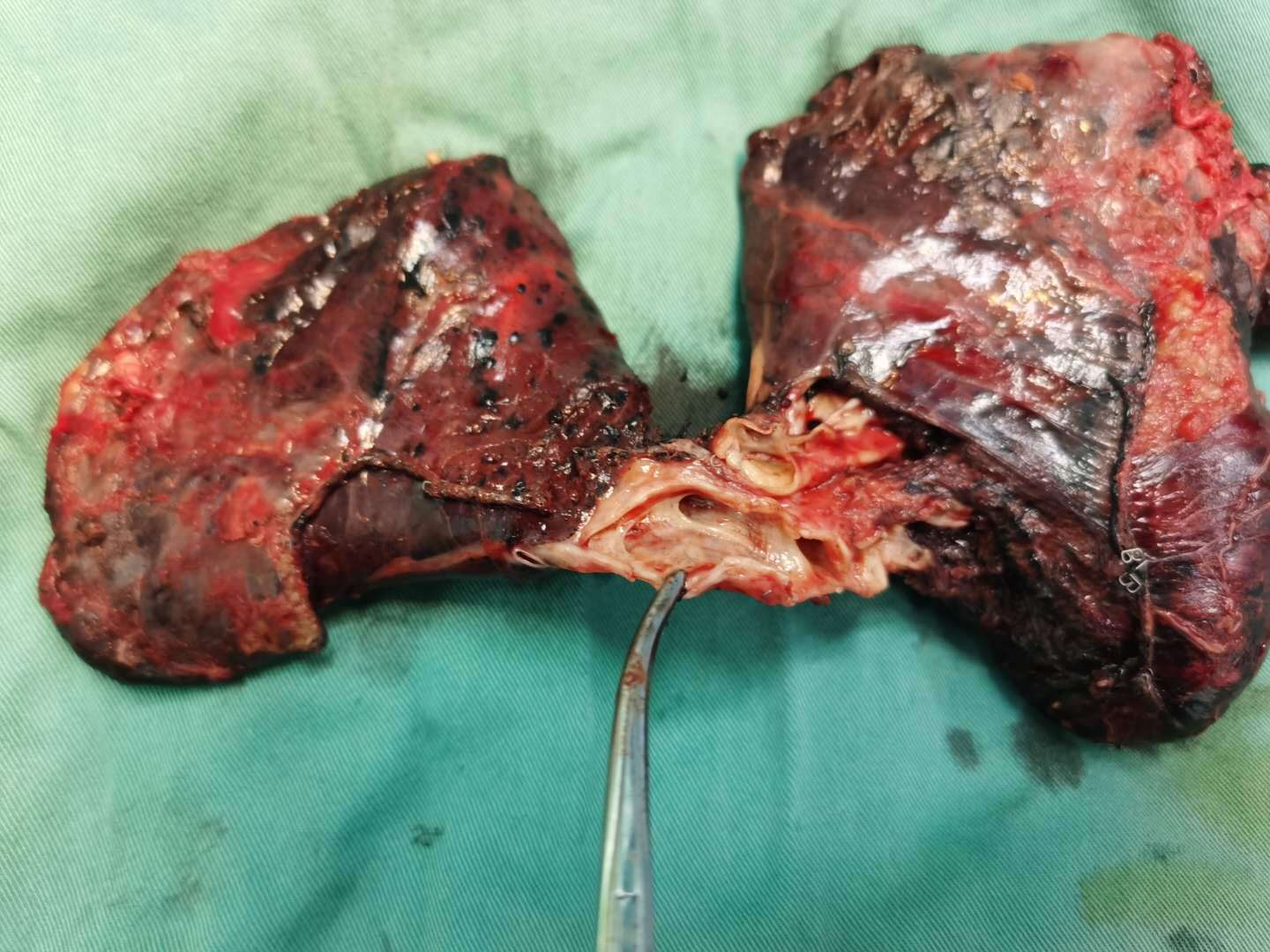 贝伐单抗的抗肺癌效果_贝伐单抗多久有耐药性_肺癌继发性癫痫可用贝伐单抗吗