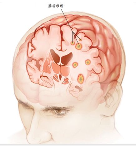 肺癌患者脑转移吃奥希替尼_肺癌患者可以吃海带吗_肺癌转移脑是什么症状