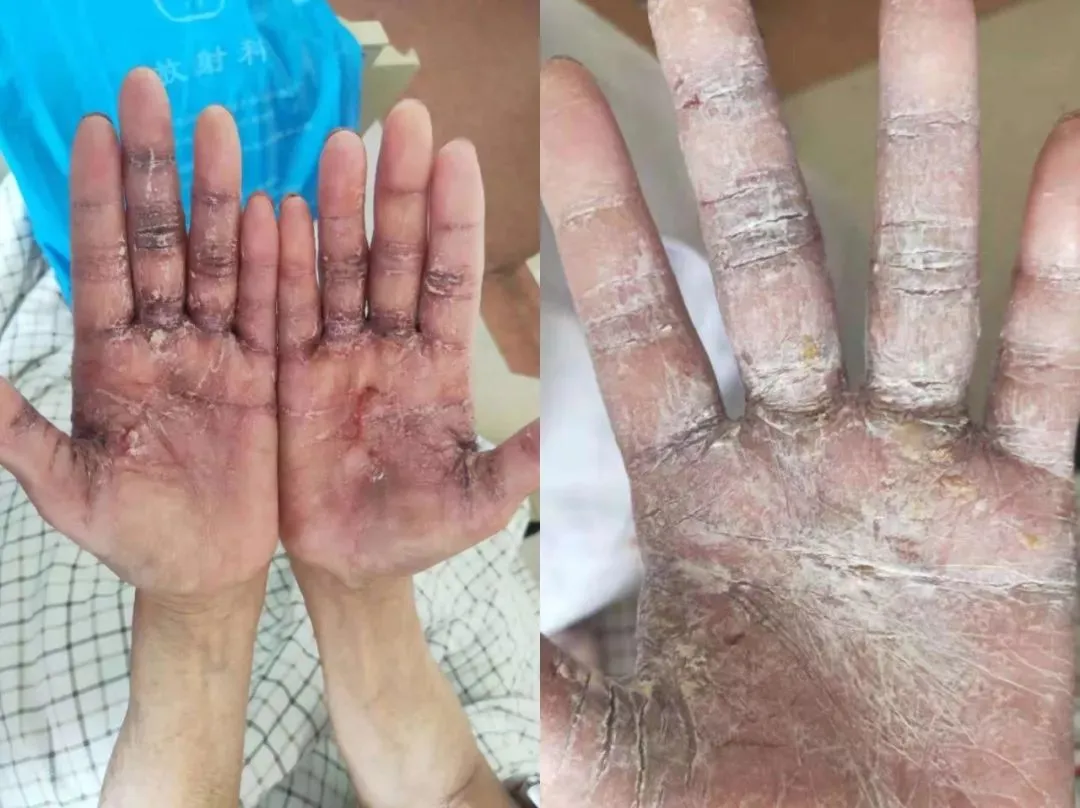 索拉非尼_索拉非尼美国_索拉非尼手足综合症