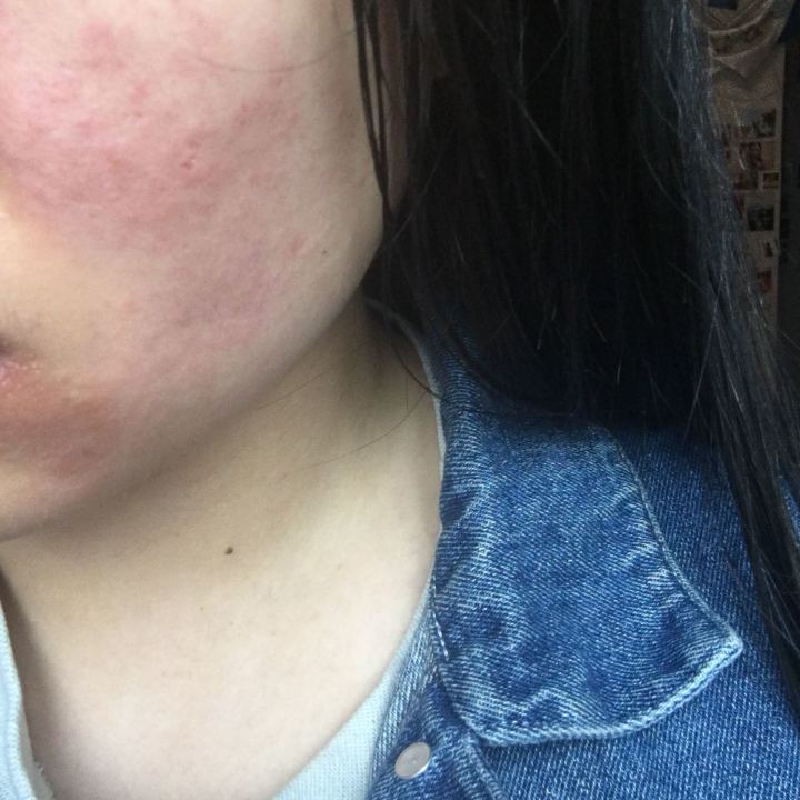 吃吉非替尼有皮肤瘙痒怎么办_吃来那替尼有腹痛的吗_舒尼替尼一盒吃多少天?