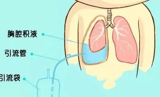 贝伐珠单抗_贝伐珠单抗靶向是啥_贝伐珠单抗单药胸腔灌注的方法