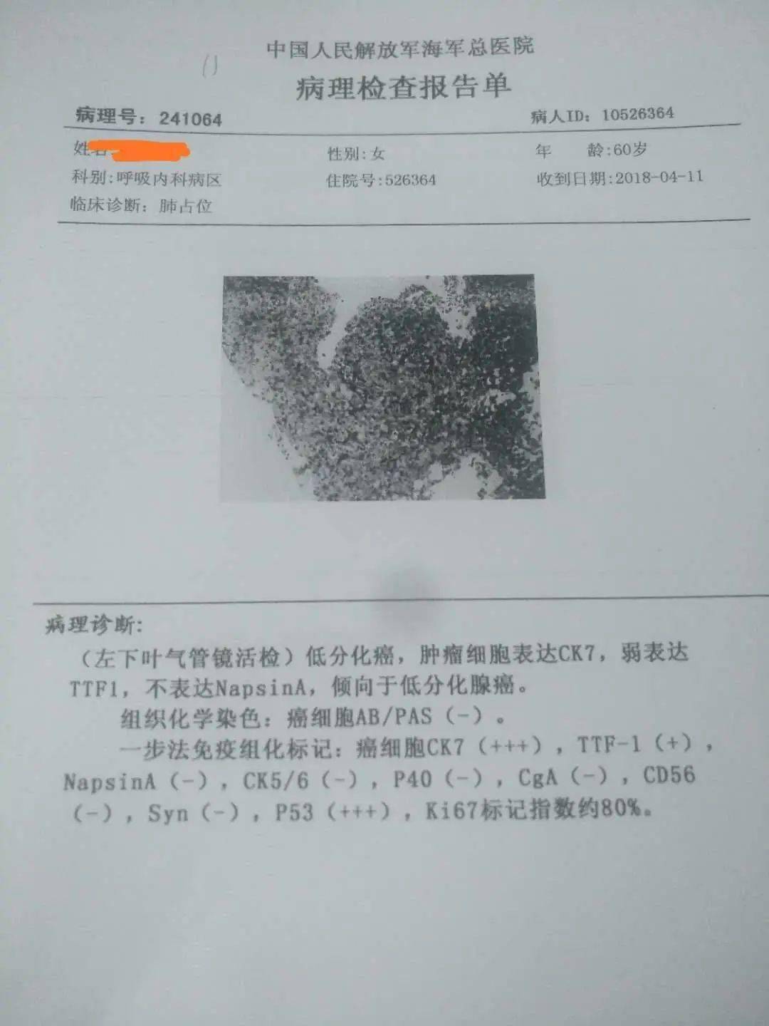 贝伐珠单抗 耐药性_贝伐珠单抗肝细胞癌适应症_贝伐珠单抗是化疗吗