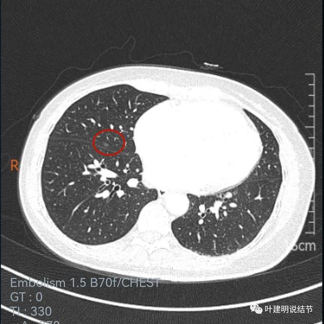 克唑替尼治愈肺癌案例_奥斯替尼和奥希替尼_奥希替尼9291治愈肺癌