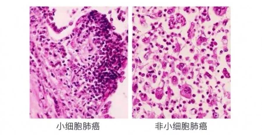 
肿瘤电场疗法——被FDA批准治疗复发性胶质母细胞瘤