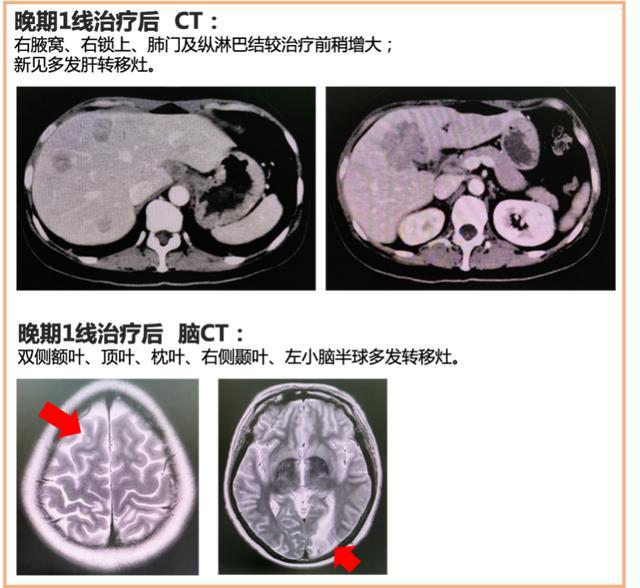服用吉非替尼副作用腹泻怎么办_服用六味地黄丸腹泻_印度舒尼替尼怎么服用