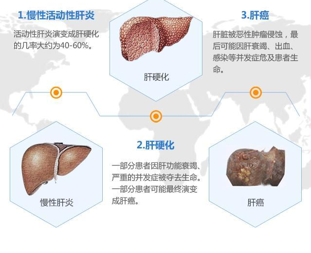 肝癌手术后能吃索拉非尼_索拉非尼肝癌辅助治疗_索拉非尼 手术