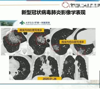 尼毕鲁杨祥吉的妻子_吃吉非替尼出现胸痛怎么处理_舒尼替尼一盒吃多少天?