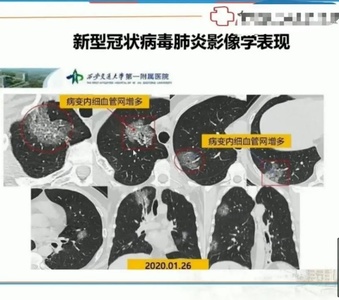 一下间质性肺炎的临床表现及护理方法有哪些？-八维教育