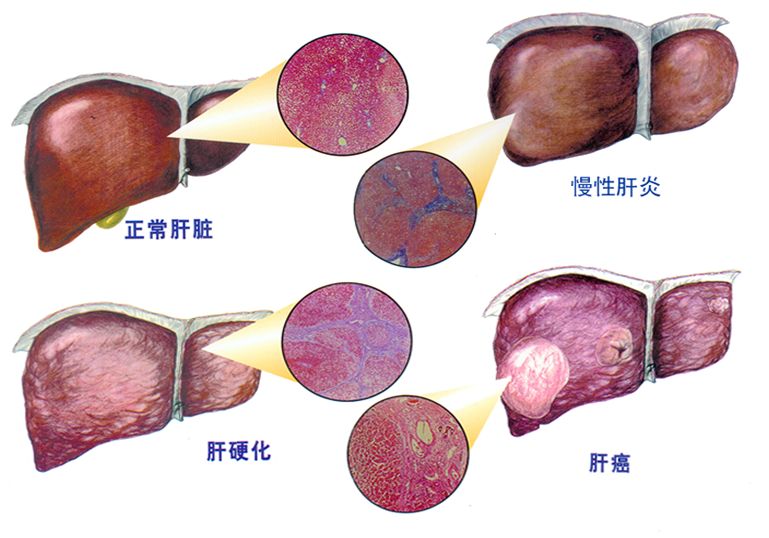 
肝癌的免疫治疗时代已经来临，如何克服耐药和提高疗效