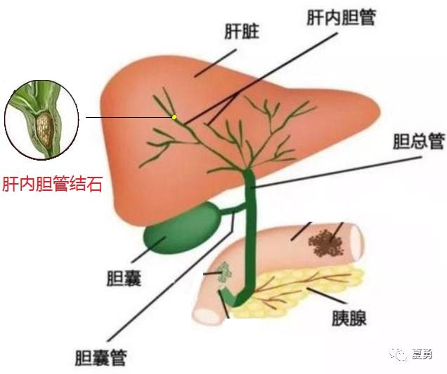 本次分享一例肝细胞肝细胞肝癌肝内转移伴癌栓形成患者