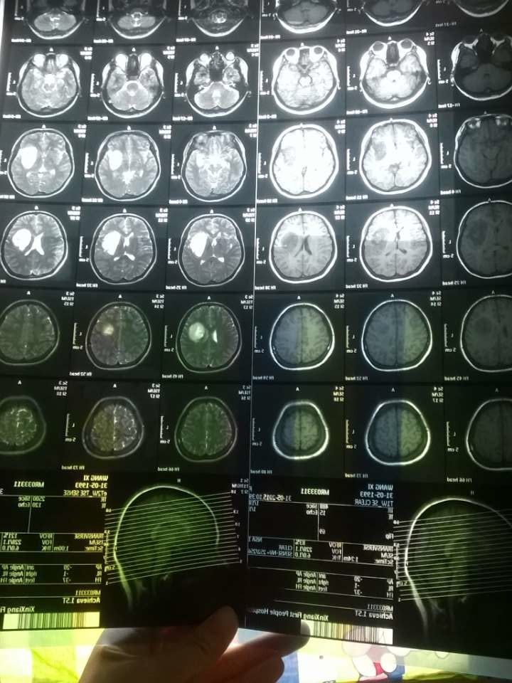 贝伐珠单抗是化疗药吗_贝伐珠单抗价格_b贝伐珠单抗