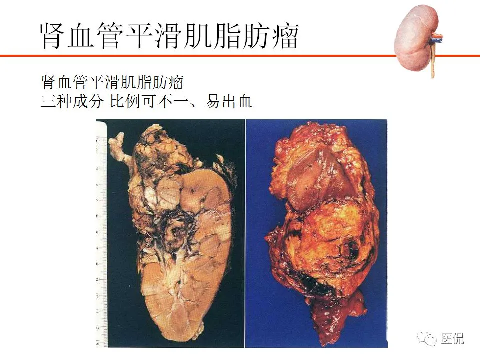 贝珠伐单抗能单独使用吗_贝伐珠单抗说明书_贝伐珠单抗靶向是啥