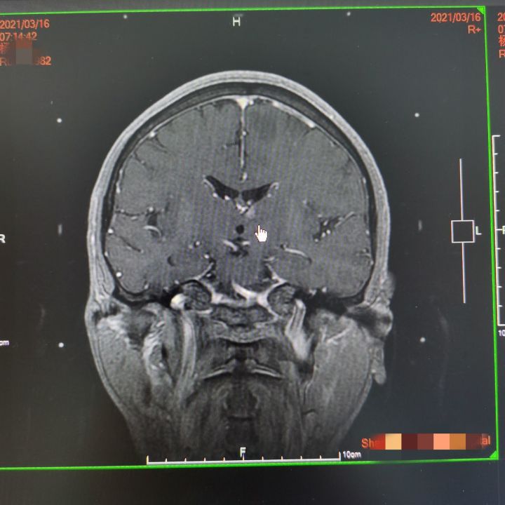 肺癌转移脑怎么治疗_肺癌脑转移吉非替尼和奥希替尼_奥斯替尼和奥希替尼