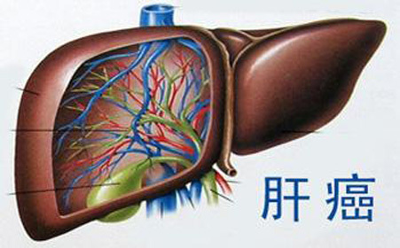 索拉非尼（多吉美）治疗肝癌的唯一靶向药-索拉非尼