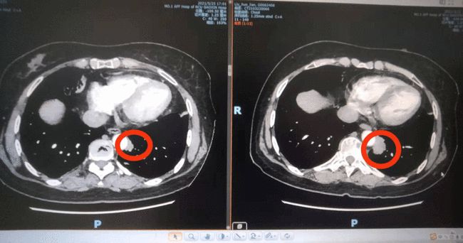 奥希替尼9291_索拉非尼要做基因检测么_奥希替尼用基因检测吗