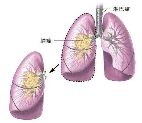 奥希替尼医保怎么报销_奥希替尼纳入医保后价格_韦立得纳入医保后多少钱一盒