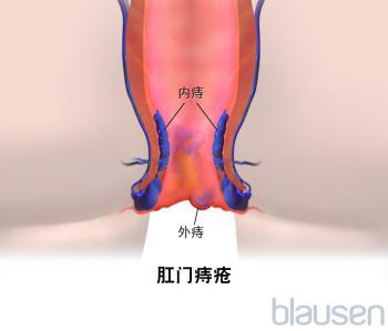 贝伐珠单抗造成出血_贝伐单抗的副作用痔疮出血_贝伐珠单抗4个月后赠药