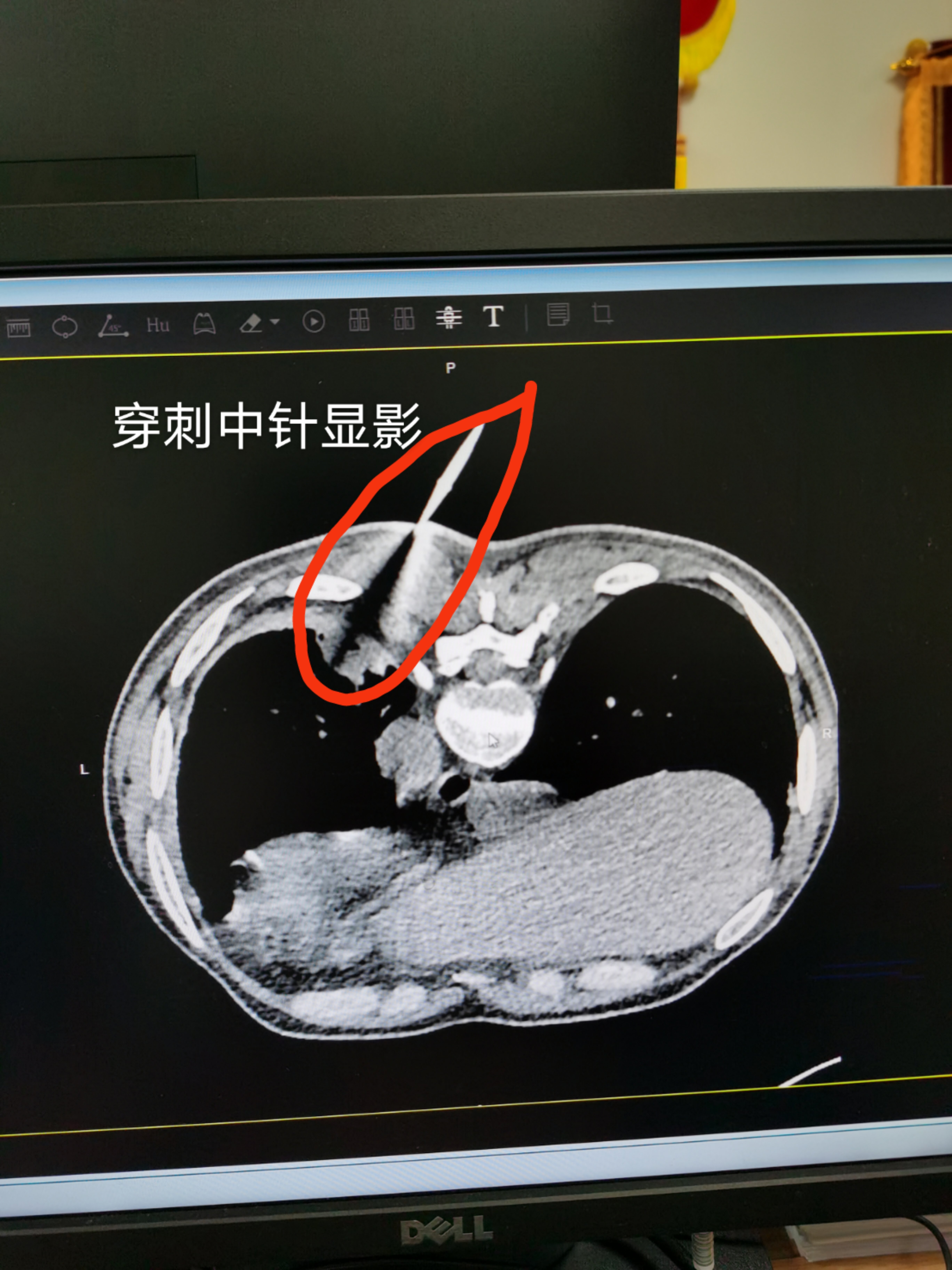 骨折后吃黄瓜子粉有用吗_骨质疏松吃仙林骨宝有用吗_肺癌骨转移吃吉非替尼有用吗