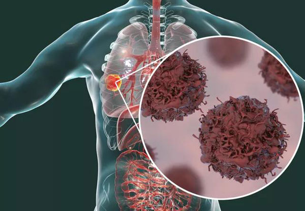 
奥希替尼可以携带特定突变的非小细胞肺癌