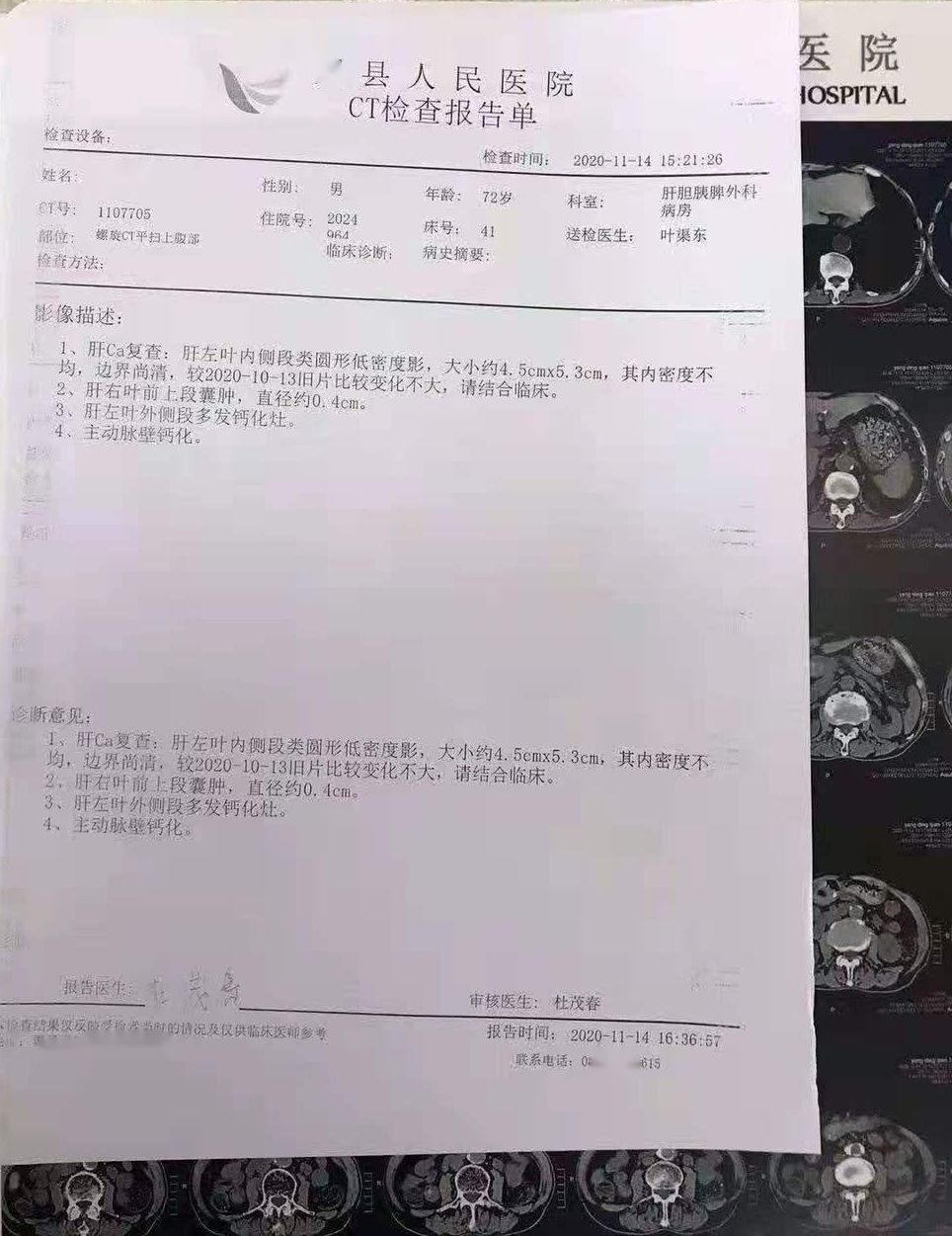 索拉非尼 肝癌有效率_弥漫性肝癌晚期服用索拉非尼_索拉非尼吃好了肝癌