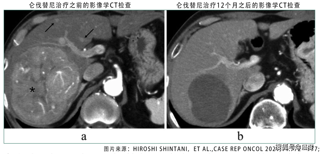 索拉非尼 肝癌有效率_索拉非尼吃好了肝癌_弥漫性肝癌晚期服用索拉非尼