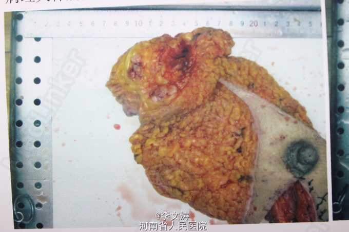 贝伐单抗对脑转移癌有效_贝伐单抗乳腺癌新辅助_贝伐珠单抗是化疗药吗