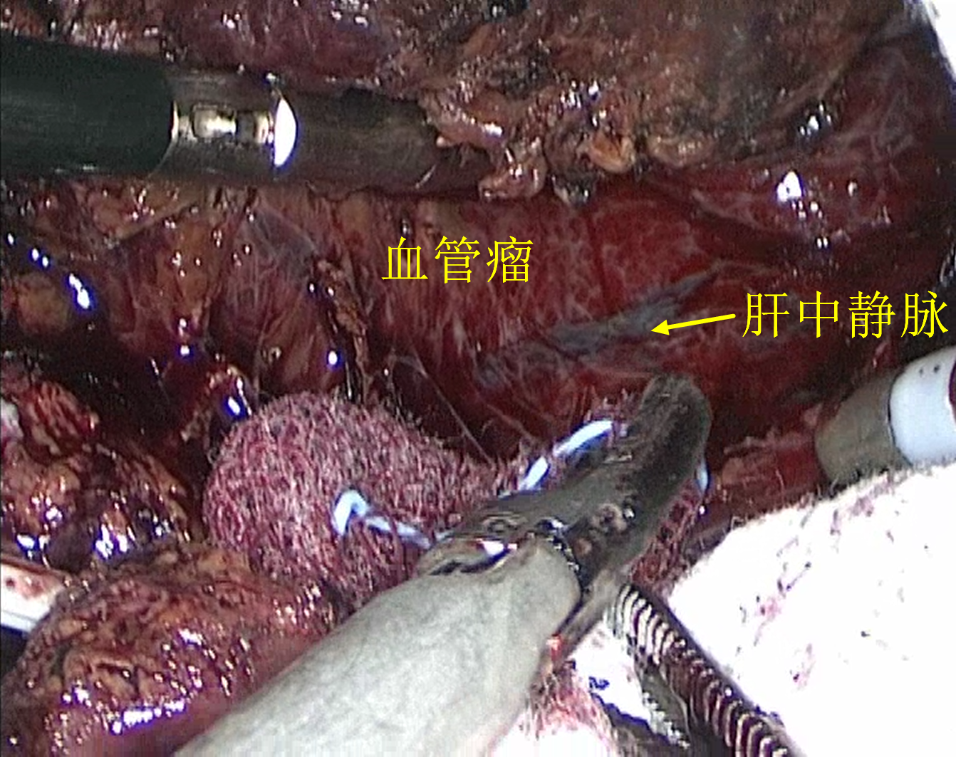 贝伐单抗口腔溃疡化脓_肺癌新药贝伐单抗_贝伐单抗-阿瓦斯汀大陆卖多少钱?