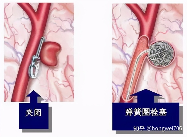 贝伐单抗口腔溃疡化脓_贝伐单抗-阿瓦斯汀大陆卖多少钱?_肺癌新药贝伐单抗