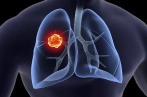 肺癌肝转移 靶向药_肺癌骨转移的靶向治疗_肺癌骨转症状靶向药奥希替尼