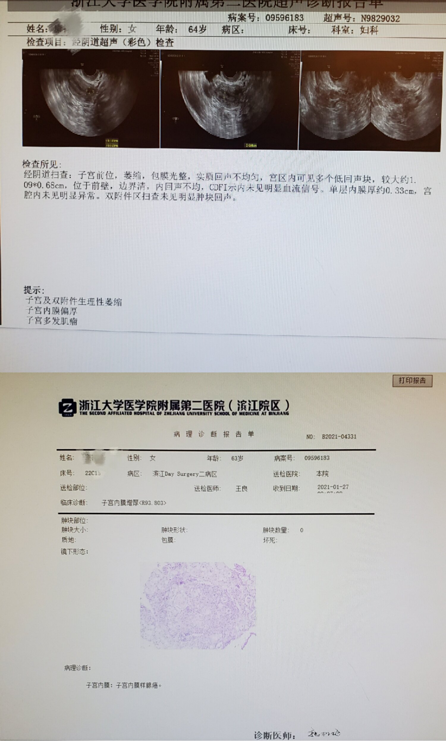 贝伐珠单抗注射液_贝伐珠单抗4个月后赠药_贝伐珠单抗临床试验副作用