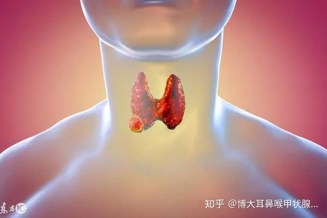 印度索拉非尼效果_索拉非尼对甲状腺癌的效果_甲状腺良性癌跟恶性癌