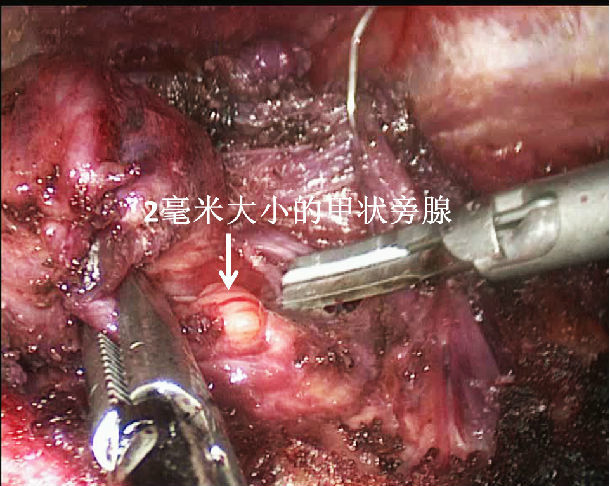 甲状腺乳头状癌不算癌_索拉非尼对甲状腺癌的效果_甲状腺结节癌未分化癌