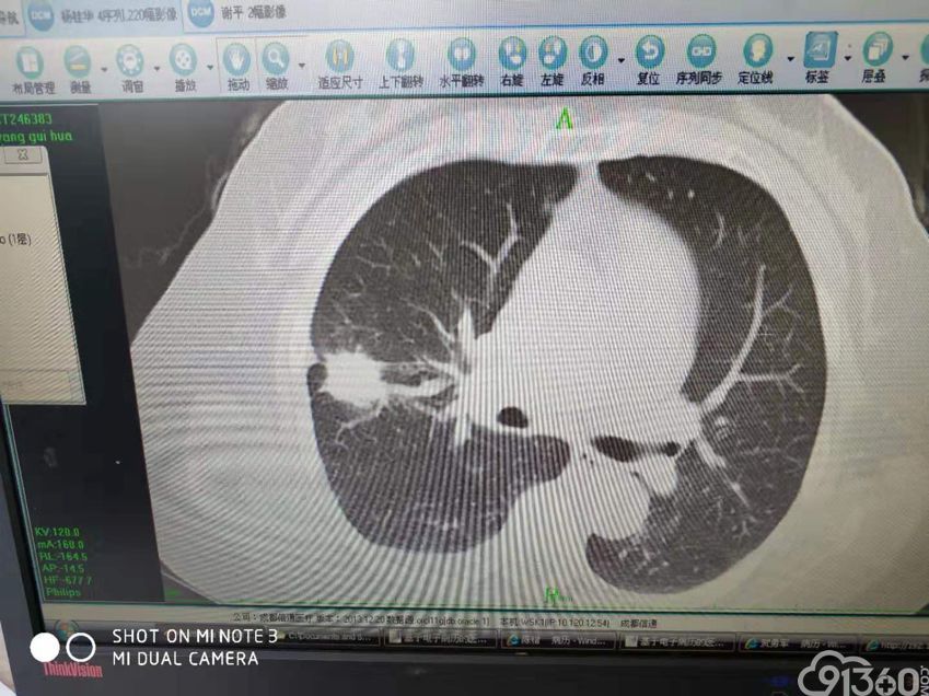 达卡易购：吉非替尼肺癌晚期患者的生存质量