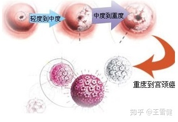 贝伐珠单抗多久用一次_宫颈腺癌适合用贝伐单抗价格_肺癌新药贝伐单抗