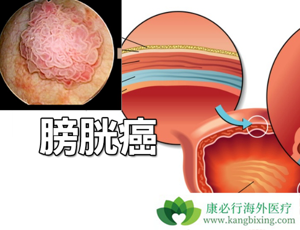 印度易瑞沙替尼口服的表皮生长因子受体酪氨酸激酶(吉非替尼片)