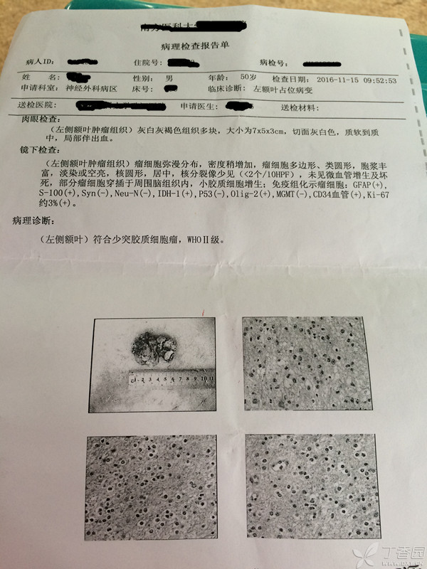贝伐珠单抗可以报销吗_贝伐单抗是靶向药吗_胶质瘤四级术后贝伐单抗