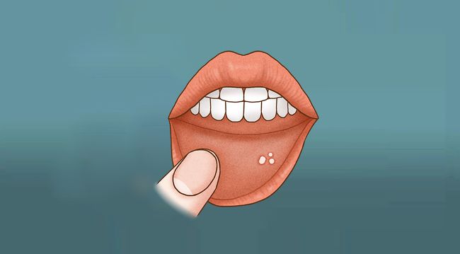 口腔溃疡长久不愈，小心是癌！这些因素一定要注意！