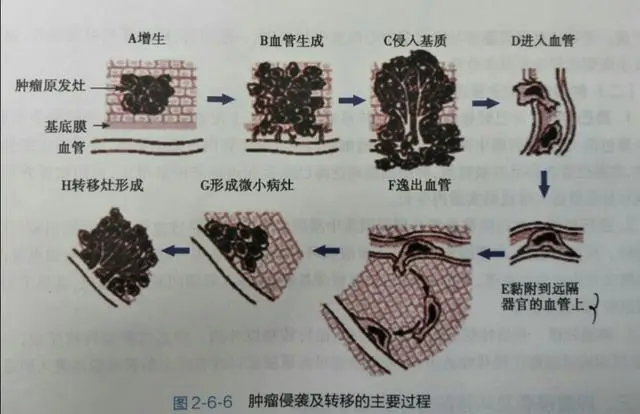 贝伐珠单抗在妇科肿瘤领域的两项新适应症获国家药品监督管理局批准