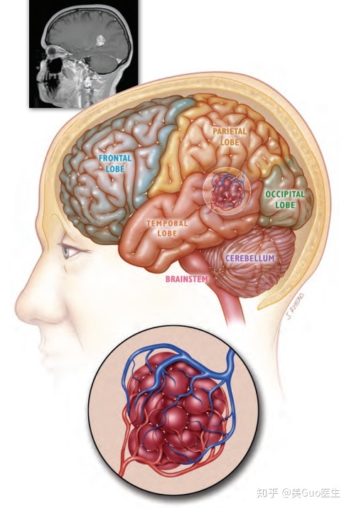 传统的MRI典型表现以及内皮细胞坏死的危险因素有哪些