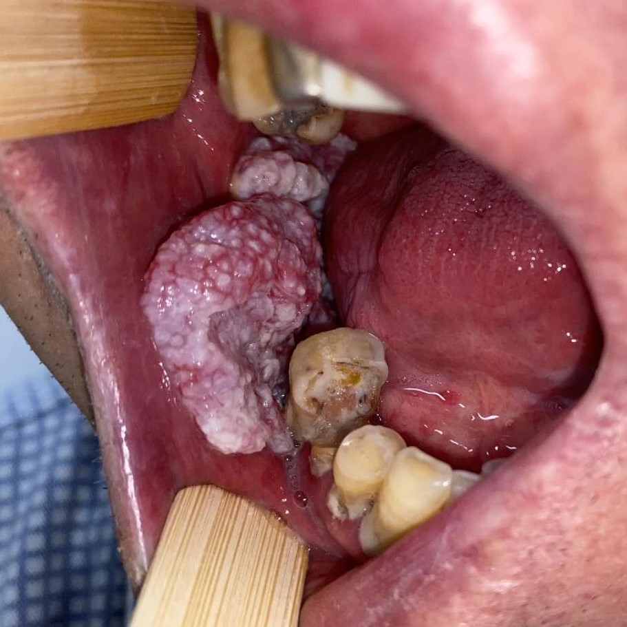 门静脉癌栓 索拉非尼_索拉非尼 说明书_索拉非尼治疗卵巢癌有效吗